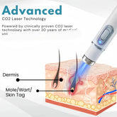 Nexusdrop Acne Removal Laser
